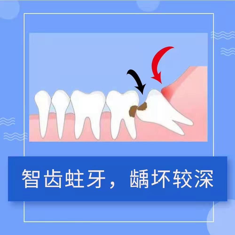 图解|智齿还是拔吧！(图1)