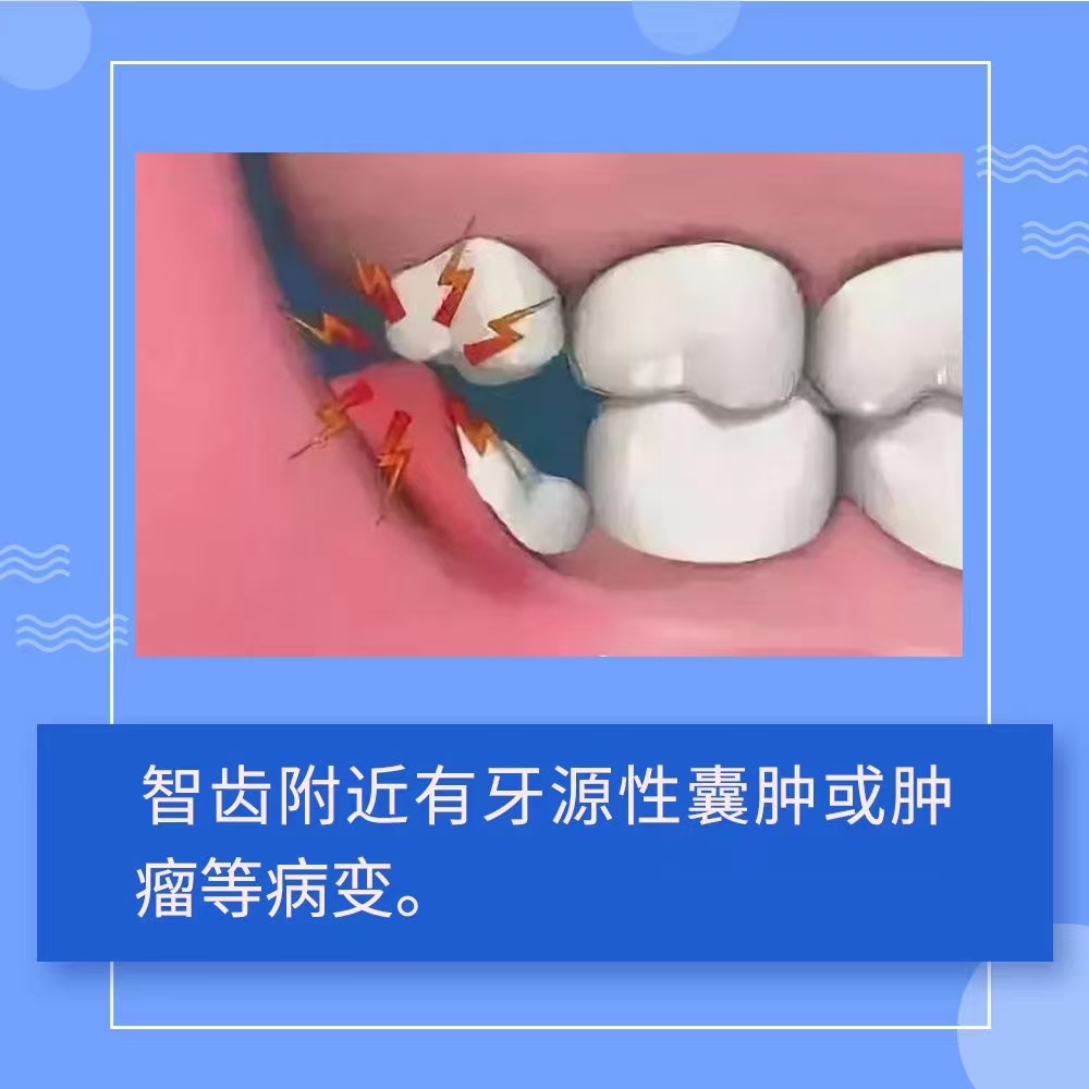图解|智齿还是拔吧！(图4)