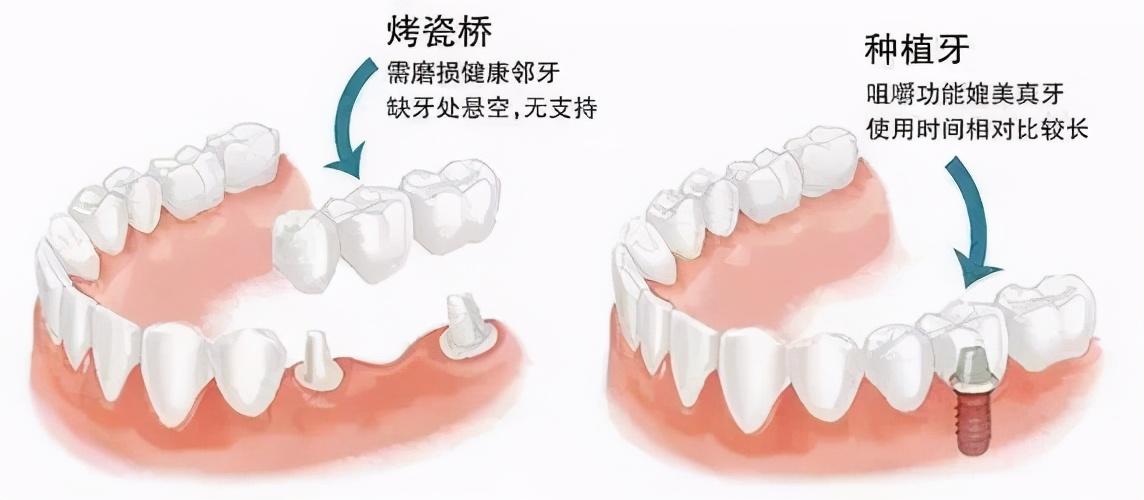 问答|缺了一颗牙，怎么修复？ (图1)