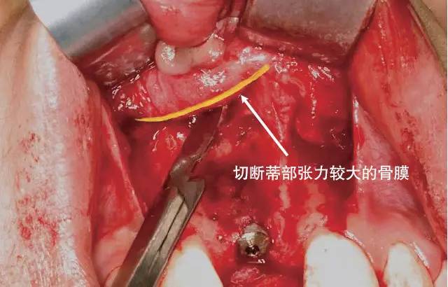 口腔种植手术学图解 组织切开与翻瓣(图15)