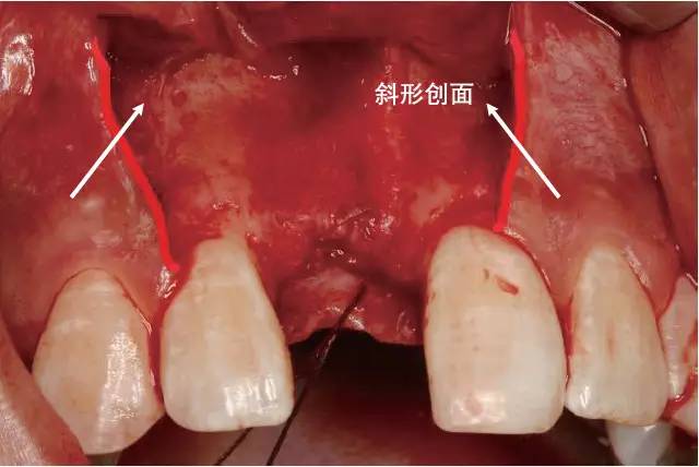 口腔种植手术学图解 组织切开与翻瓣(图14)