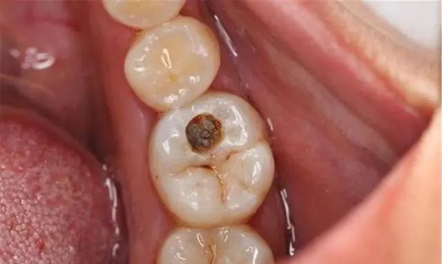 看了这些,你还敢不刷牙吗?(图7) 看了这些,你还敢不刷牙吗?(图7)