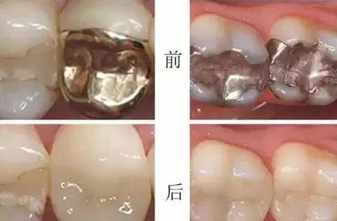 牙齿修复选嵌体!为什么?(图3) 图片