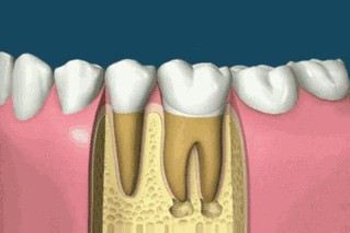 根管治疗后牙齿的寿命一般是多久?为啥宁愿拔牙也不做根管(图2)