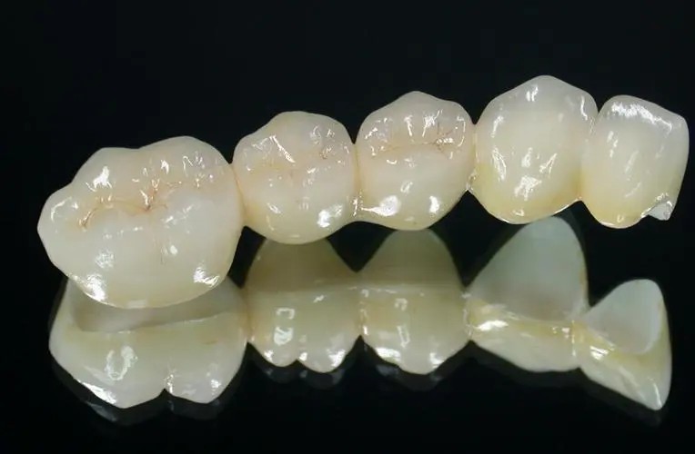 牙齿黄做烤瓷牙好还是贴面好？哪个性价比高一些？(图2)