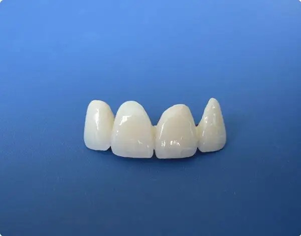 牙齿黄做烤瓷牙好还是贴面好？哪个性价比高一些？(图3)