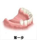 了解一下 !牙齿种植看过来(图2) 图片