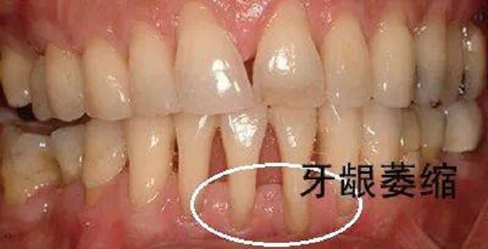 牙龈萎缩对比图